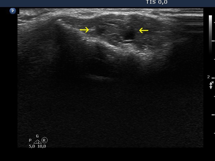 Right lobe, longitudinal scan