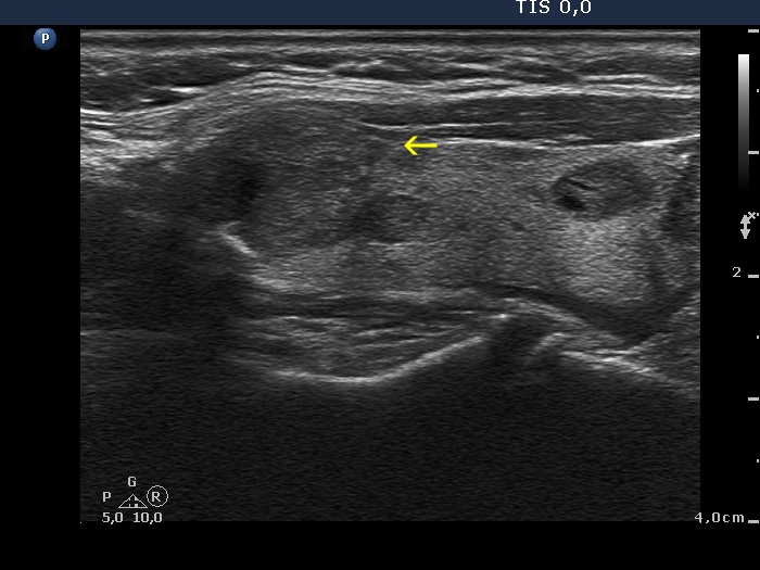 Right lobe, longitudinal scan