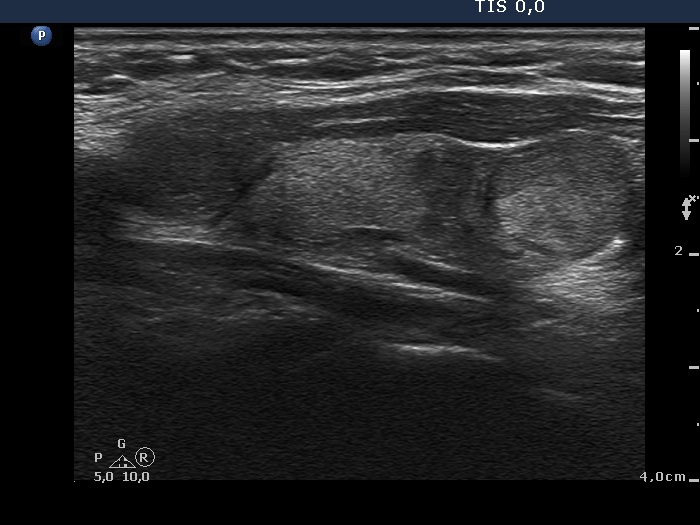 Right lobe, longitudinal scan