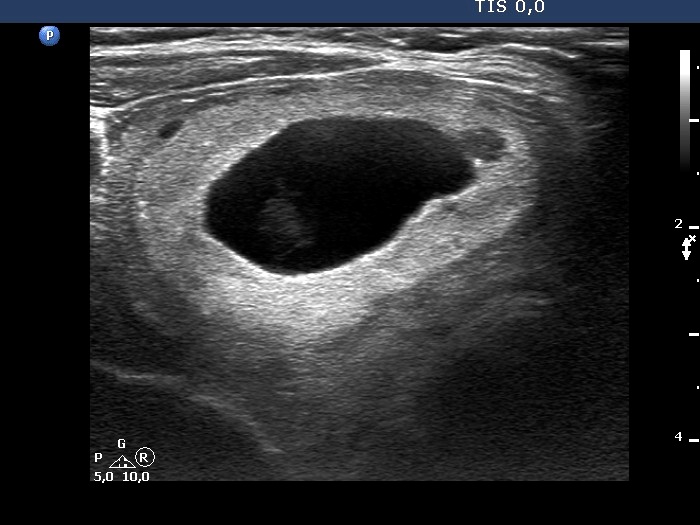 Right lobe, longitudinal scan