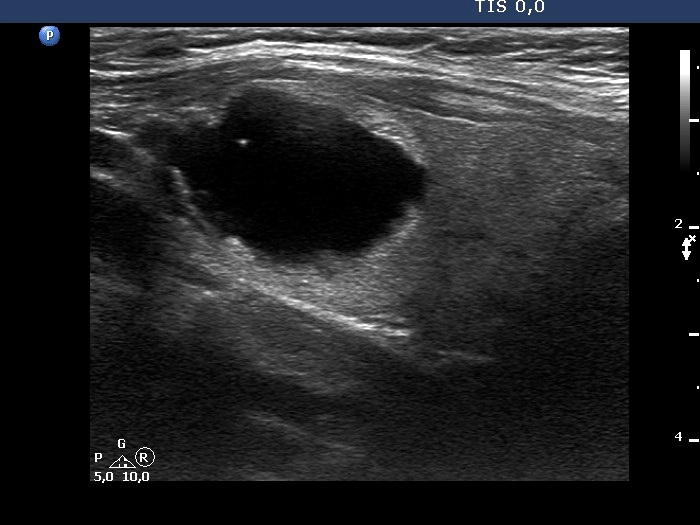 Right lobe, longitudinal scan