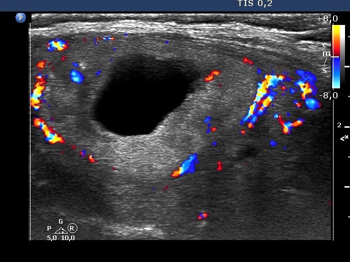 Right lobe, longitudinal scan