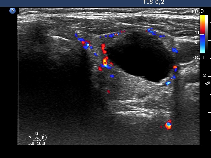 Right lobe, longitudinal scan