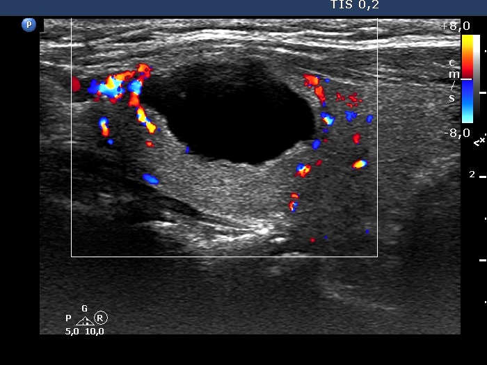 Right lobe, longitudinal scan