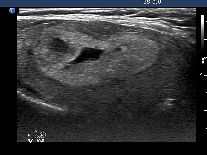 Right lobe, longitudinal scan
