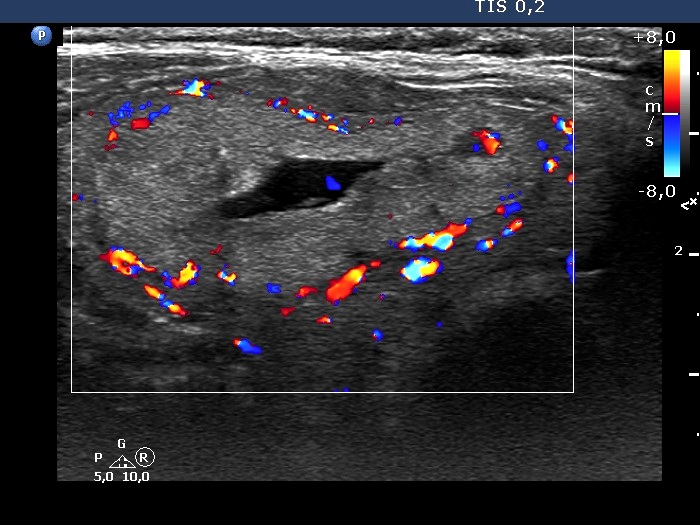 Right lobe, longitudinal scan