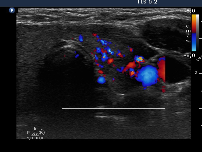 Right lobe, longitudinal scan