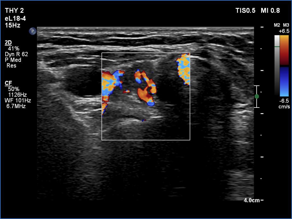 Right lobe, longitudinal scan