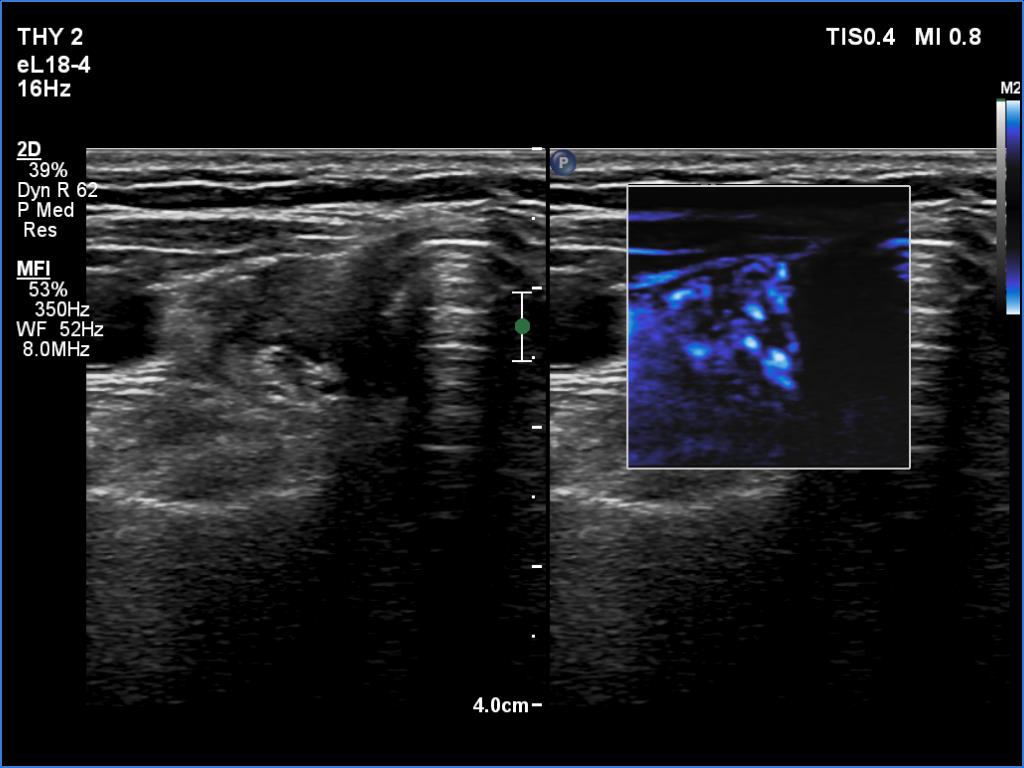 Right lobe, longitudinal scan
