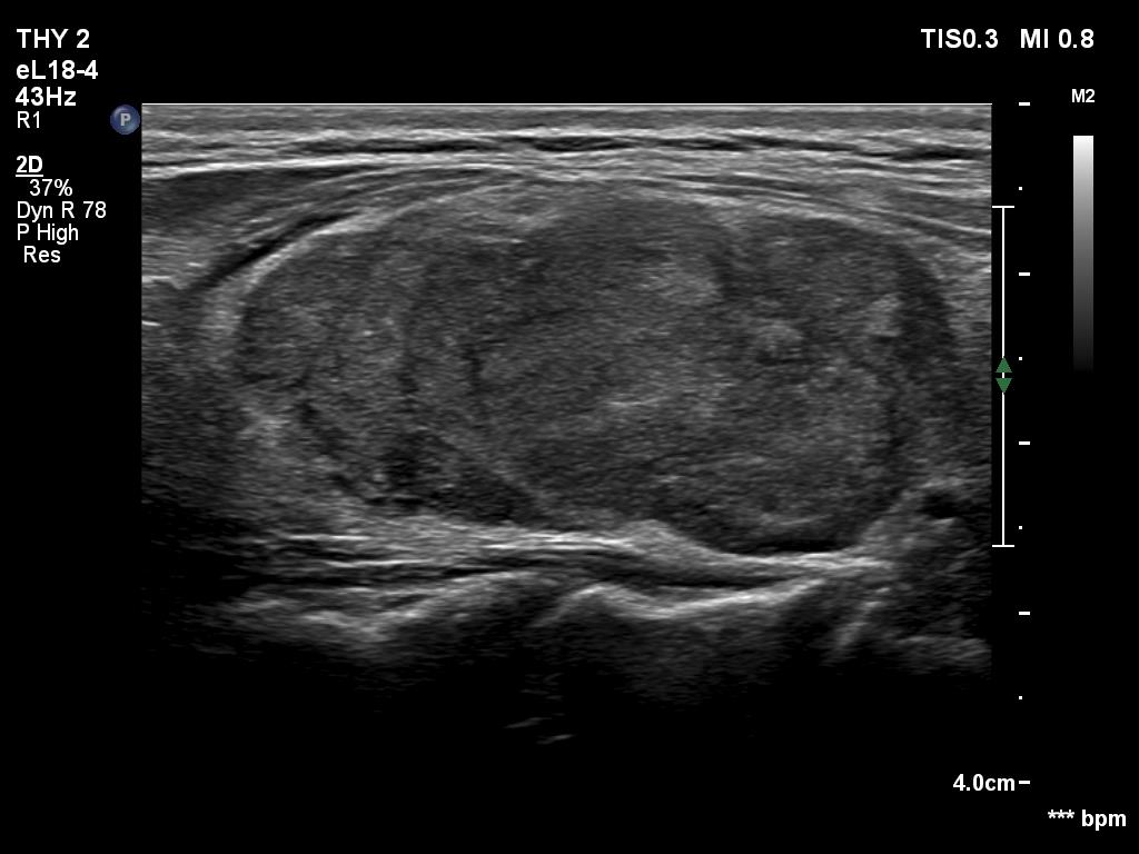 Right lobe, longitudinal scan