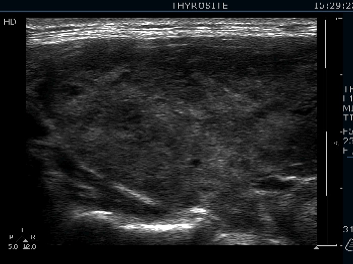 Right lobe, longitudinal scan