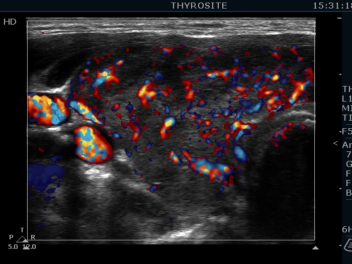 Right lobe, longitudinal scan