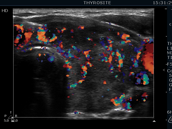 Right lobe, longitudinal scan
