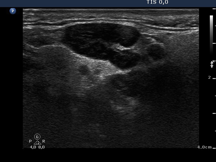 Right lobe, longitudinal scan