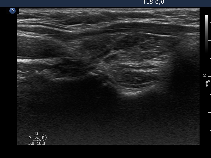 Right lobe, longitudinal scan