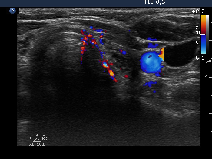 Right lobe, longitudinal scan
