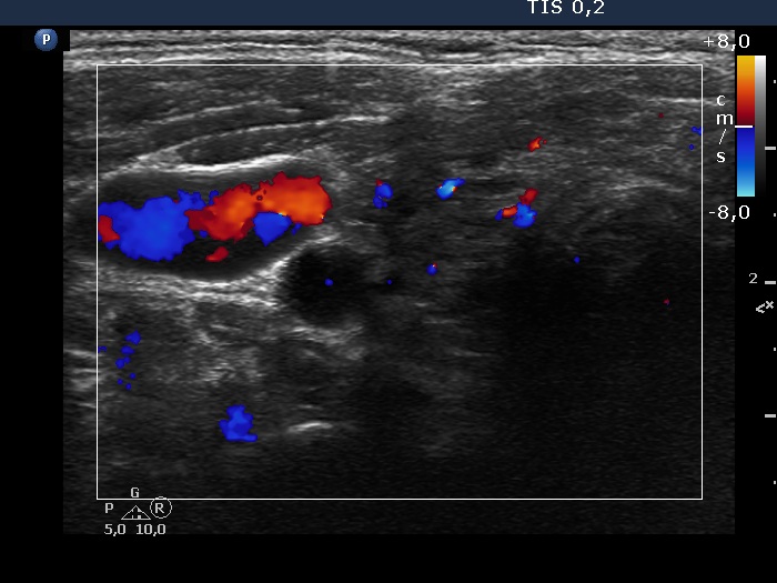 Right lobe, longitudinal scan