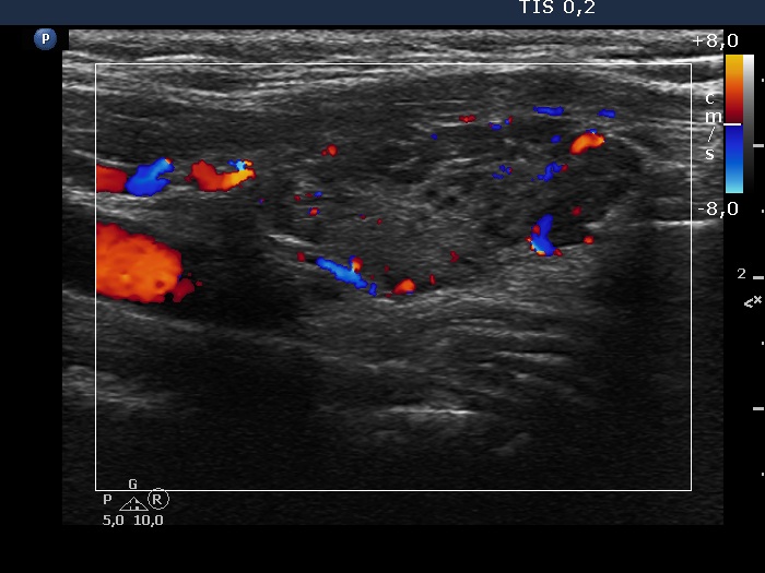 Right lobe, longitudinal scan