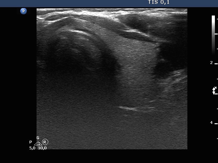 Right lobe, longitudinal scan