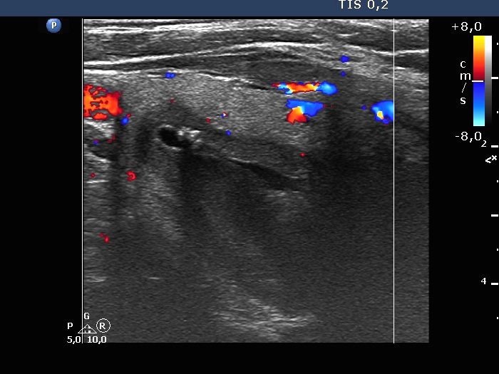 Right lobe, longitudinal scan
