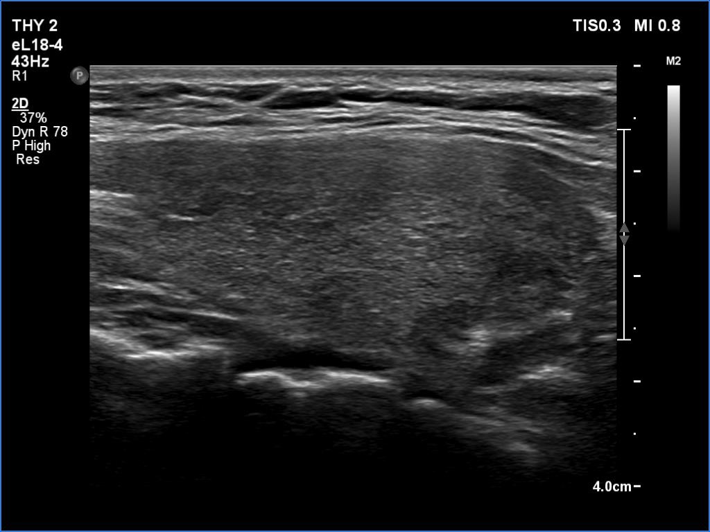 Right lobe, longitudinal scan