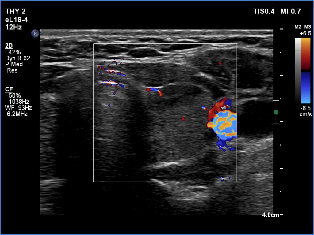 Right lobe, longitudinal scan