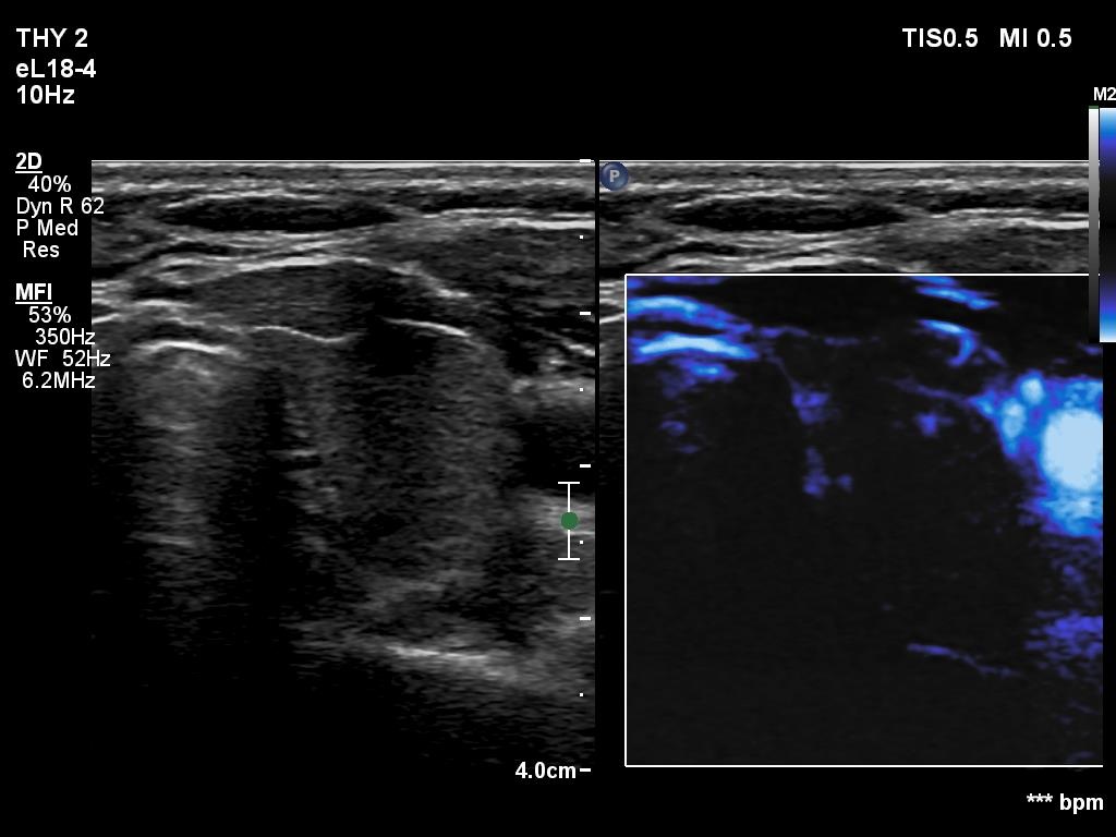 Right lobe, longitudinal scan