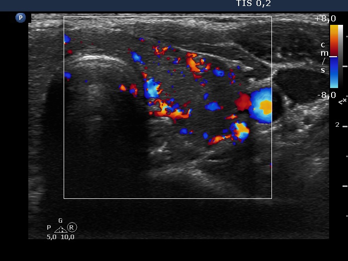 Right lobe, longitudinal scan