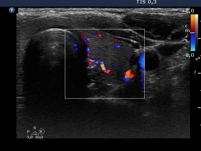 Right lobe, longitudinal scan