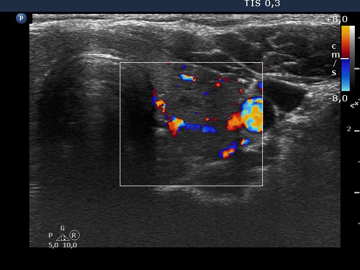 Right lobe, longitudinal scan