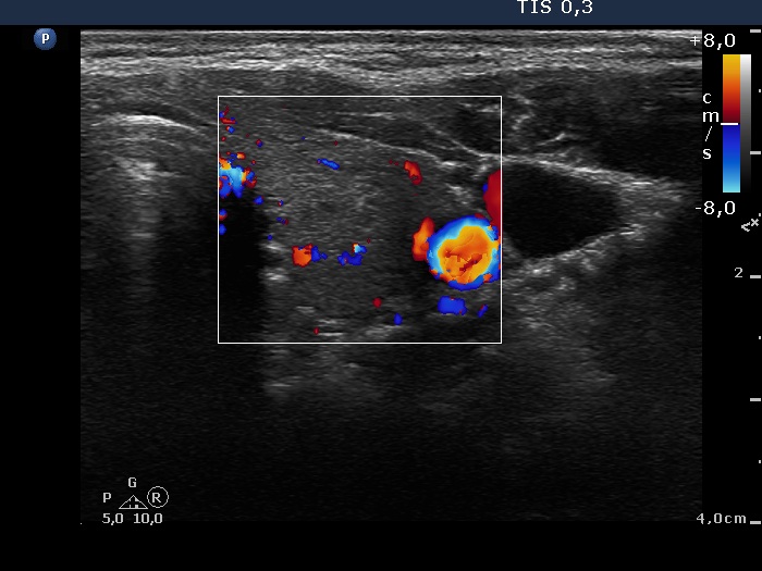 Right lobe, longitudinal scan