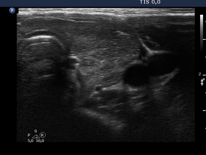 Right lobe, longitudinal scan