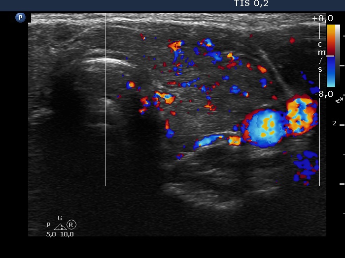 Right lobe, longitudinal scan