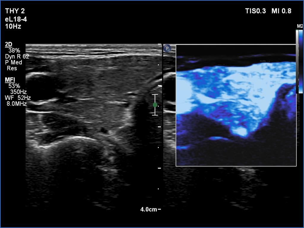 Right lobe, longitudinal scan