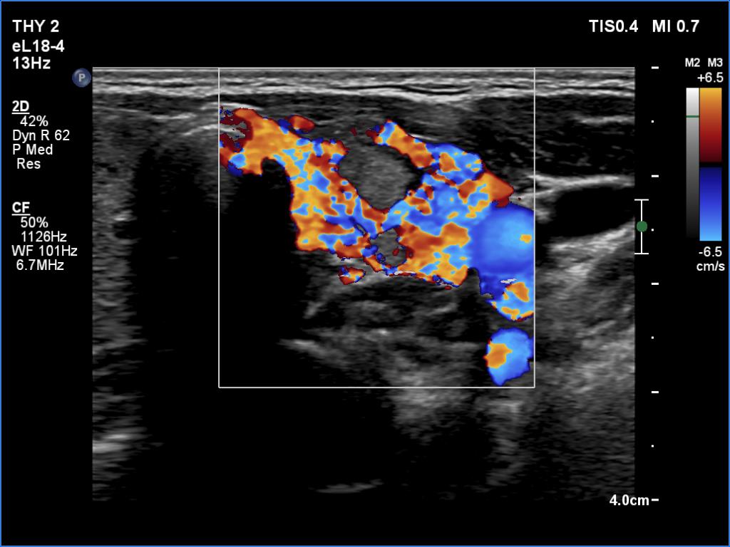 Right lobe, longitudinal scan