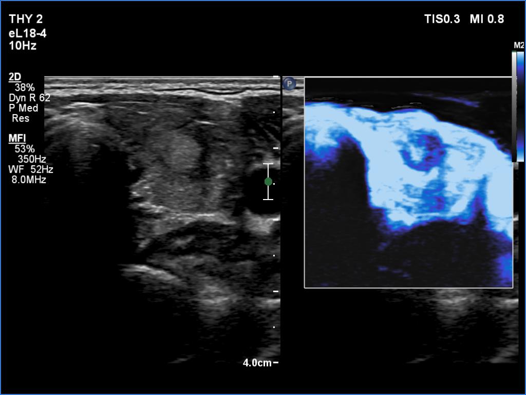 Right lobe, longitudinal scan