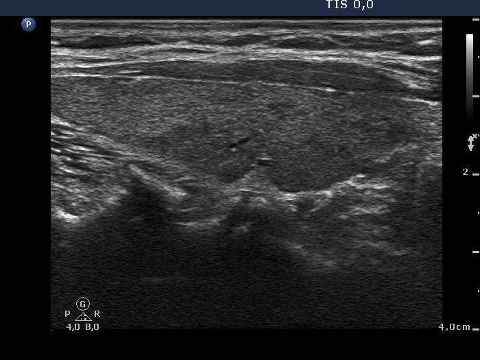 Right lobe, longitudinal scan