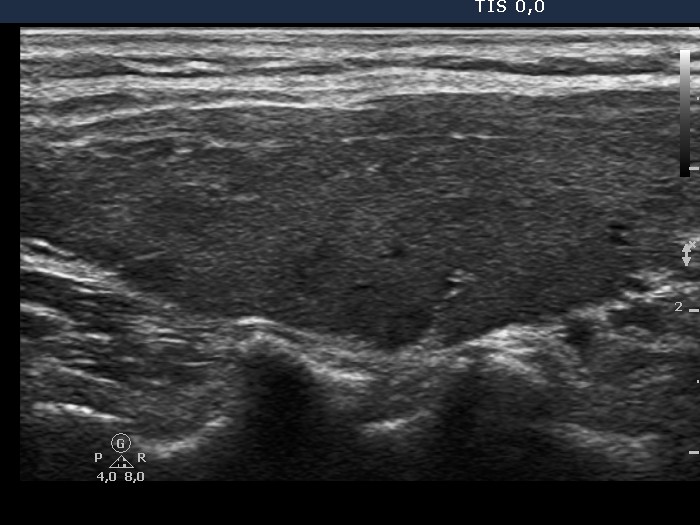 Right lobe, longitudinal scan