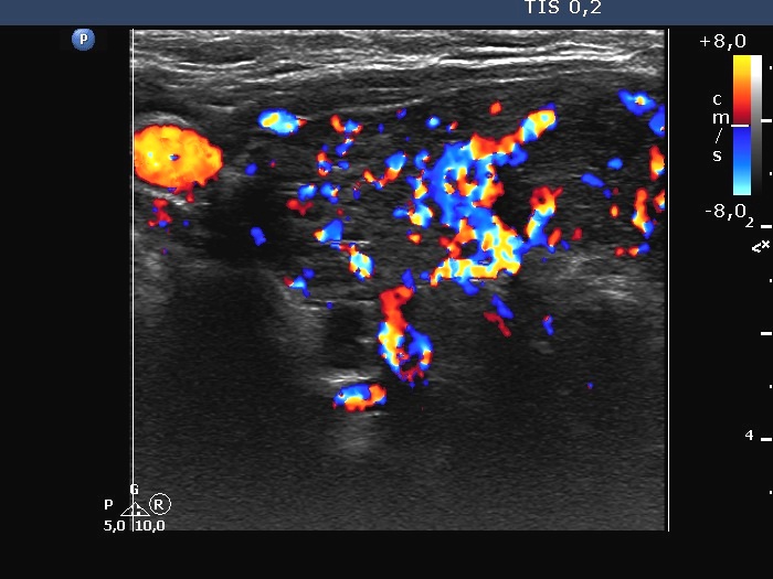 Right lobe, longitudinal scan
