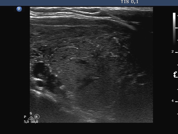 Right lobe, longitudinal scan