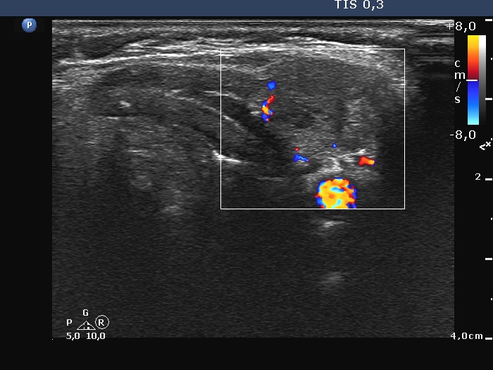 Right lobe, longitudinal scan
