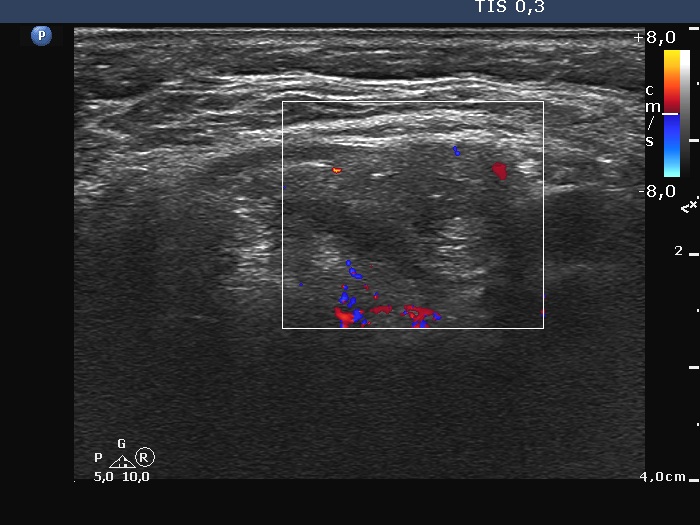 Right lobe, longitudinal scan