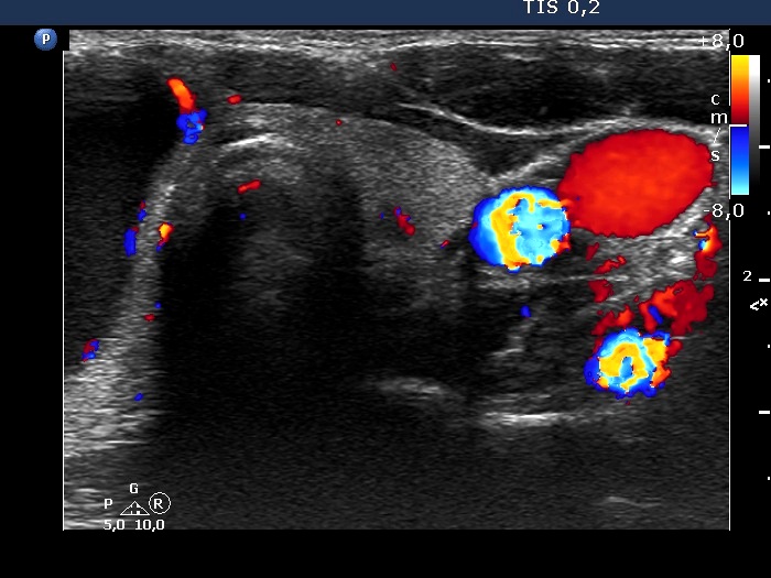 Right lobe, longitudinal scan