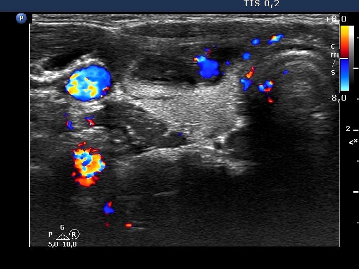 Right lobe, longitudinal scan