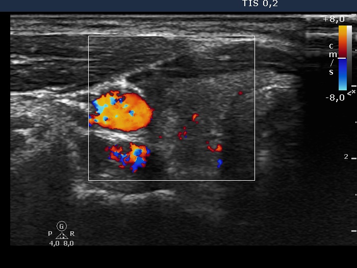 Right lobe, longitudinal scan