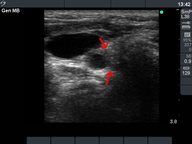 Right lobe, horizontal view