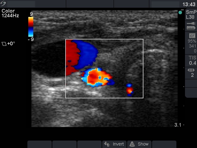 Right lobe, longitudinal scan
