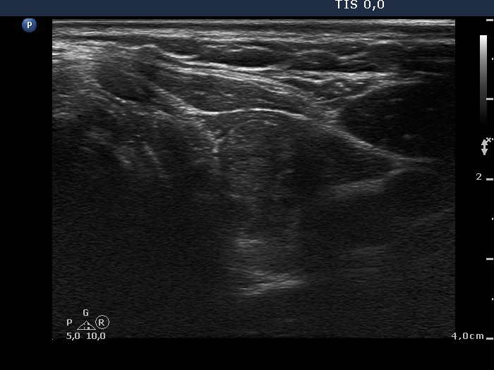 Right lobe, longitudinal scan