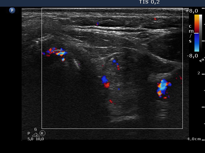 Right lobe, longitudinal scan