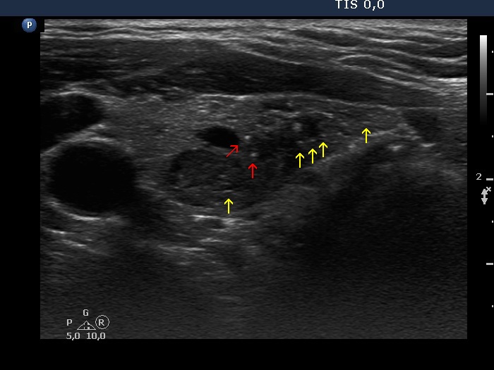 Right lobe, longitudinal scan